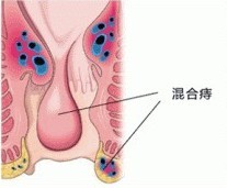 混合痔的症状有哪些?