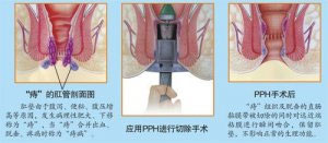 PPH微创术