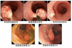 结肠息肉的症状