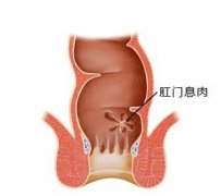 患上肛门息肉的原因?