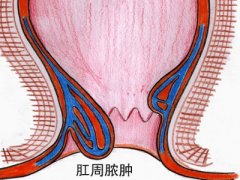 肛周脓肿对身体有什么影响?