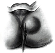 肛周脓肿的病因是什么?