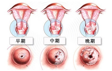 肛乳头liu与痔疮的区别