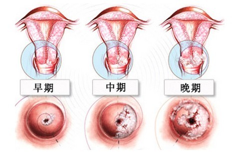 肛乳头liu三期