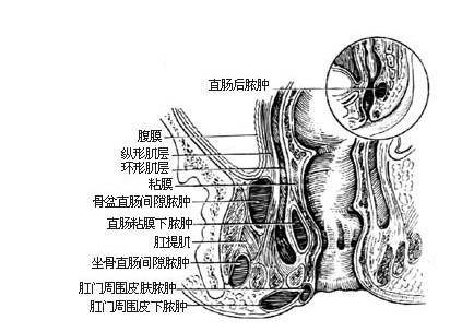 肛周脓肿日常护理