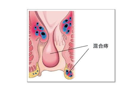 混合痔病理图