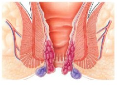 内痔康复重在保养