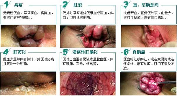 便血六大常见疾病