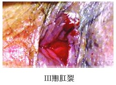 三期肛裂
