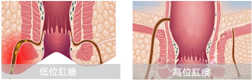 肛瘘的病情