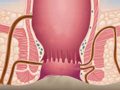 肛周脓肿有什么危害?怎么检查?