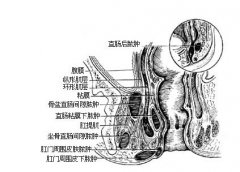 肛周脓肿为什么会得这种病?