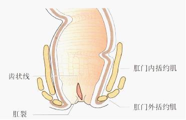 肛裂