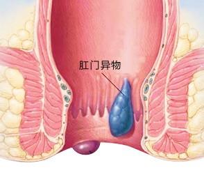 肛门异物