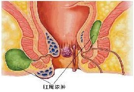 肛周脓肿术后护理
