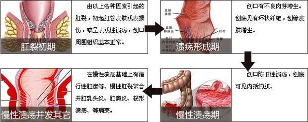 肛裂危害