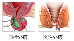 外痔疮piles如何的预防?