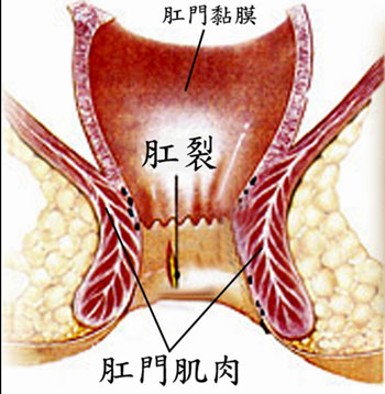 肛裂症状