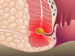 肛瘘原因