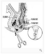 武汉肛周脓肿的危害你知多少?