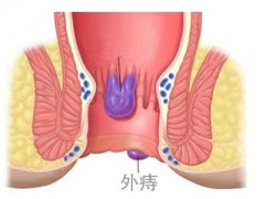 武汉炎性外痔piles是哪些原因导致的?