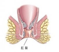 为什么会肛裂pilesask带血?