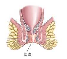 肛裂带血原因