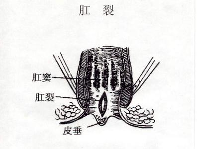 肛裂术后护理