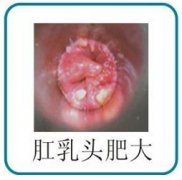 武汉肛乳头肥大的表现是什么?