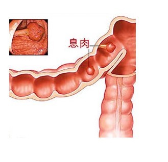 结肠息肉原因