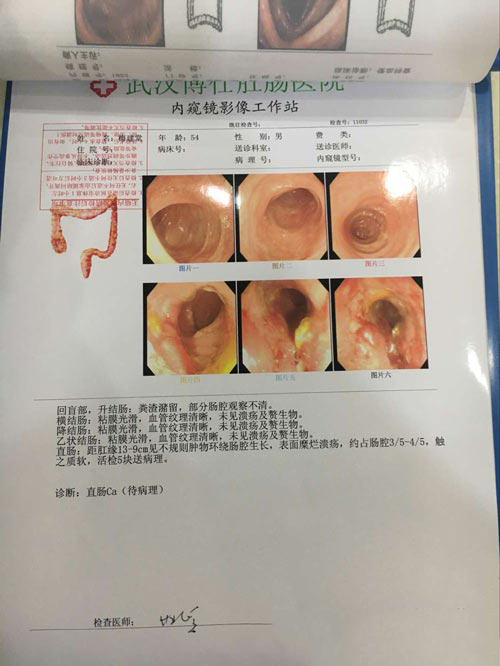 电子肛肠镜检查