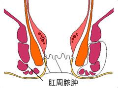 肛周脓肿分类