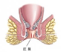 肛裂gcgt不治有哪些危害?