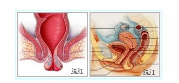 脱肛原因