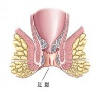 女性易患肛裂gcgt的主要原因