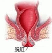 直肠脱垂有哪些预防措施?