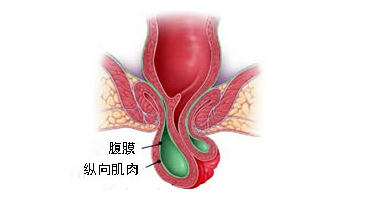 脱肛后果