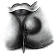 哪些因素导致肛周脓肿?