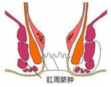 肛周脓肿不治疗严重吗?