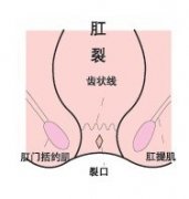 女性患上肛裂pilesask有哪些危害?