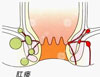 肛瘘