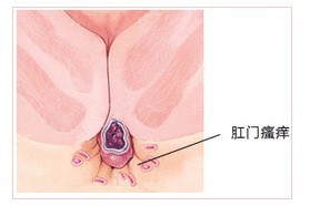 肛门瘙痒原因