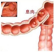 结肠息肉护理措施有哪些?