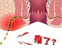 肛瘘pilesask有什么典型症状?
