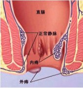 痔疮gcgt便血的症状是什么?