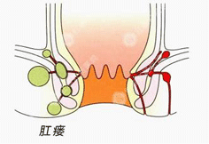 肛瘘