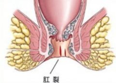 肛裂pilesask不治能自愈吗？