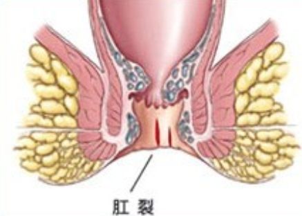 肛裂危害