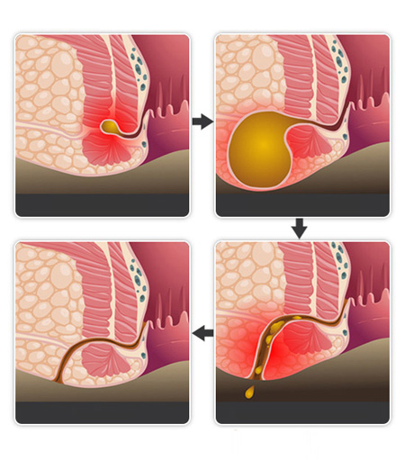肛瘘发展阶段