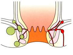 肛周脓肿原因